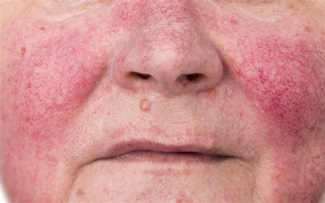 Reduce Red Blood Vessels In Face at Harry Stedman blog