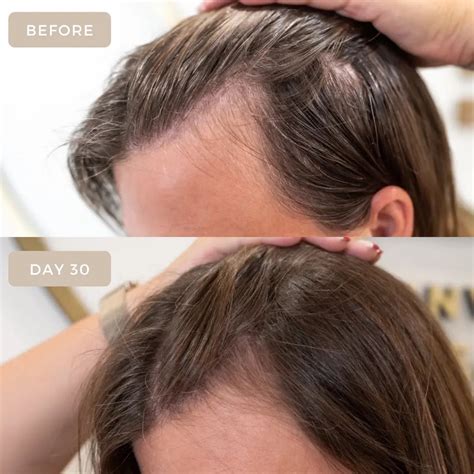 Stress Hair Loss: A Comprehensive Guide to Healthier Locks