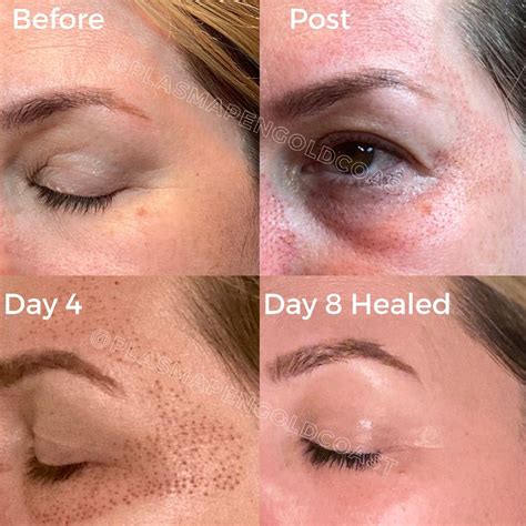 Plasma Pen Gold Coast Lower Eyelid Lift & Crows Feet | Skin tightening treatments, Facial skin ...