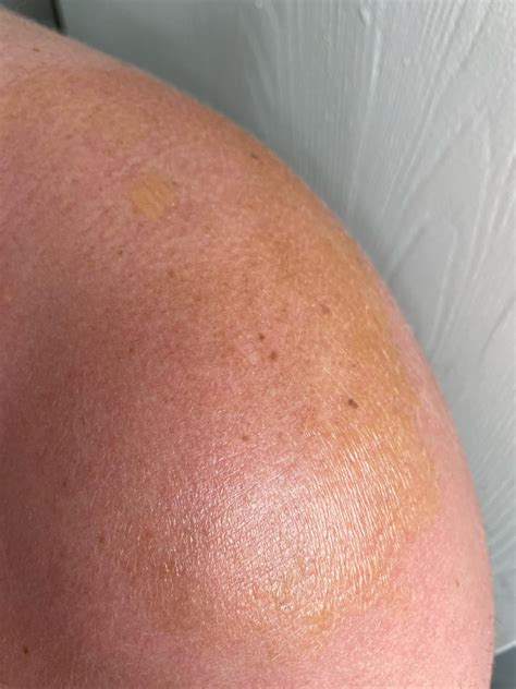 Second degree sunburn should I go to the ER? : r/DermatologyQuestions