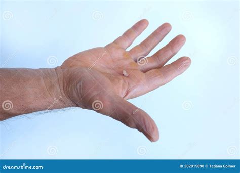 Close-up Skin with Wound on Painful Male Hand, Bursting Calluses on Palm, Rubbing of Skin with ...