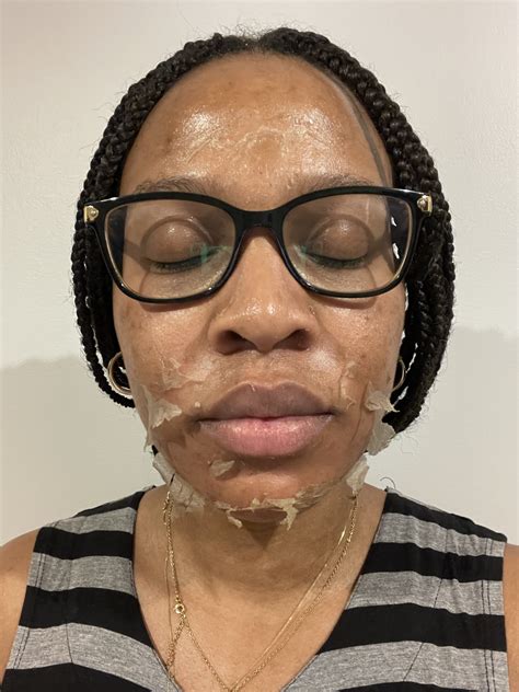 Face Wash After Chemical Peel at Mary Smithey blog