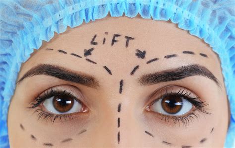 What Is An Endoscopic Forehead Lift at Leo Coughlan blog