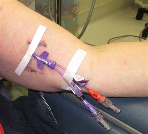 How To Keep A Picc Line Clean at Nathan Dillon blog