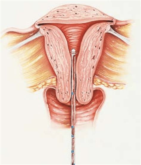 Hysteroscopy With Dilation And Curettage
