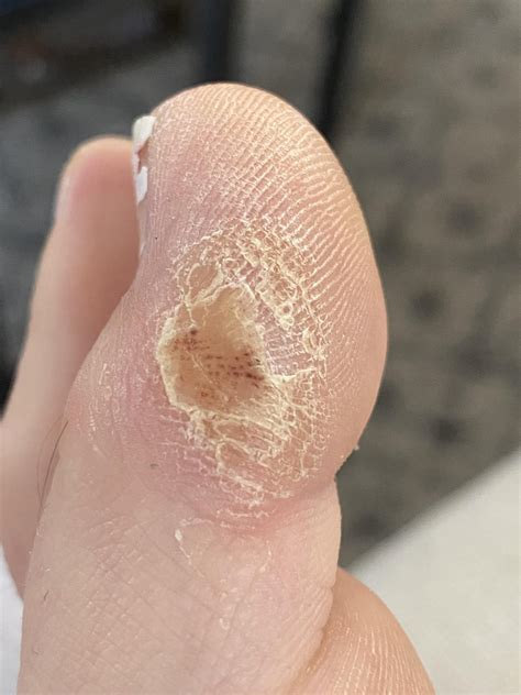 Are these things on my toes warts or calluses? I had treatments done at the derm for the warts ...