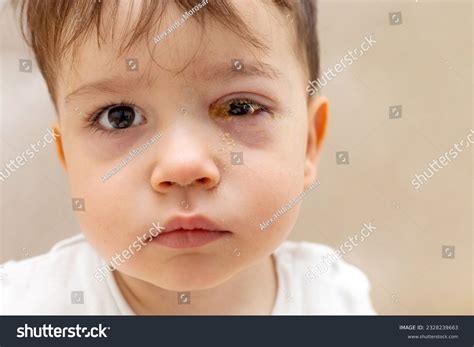 Baby Puffy Red Eyes at Anthony Monroy blog