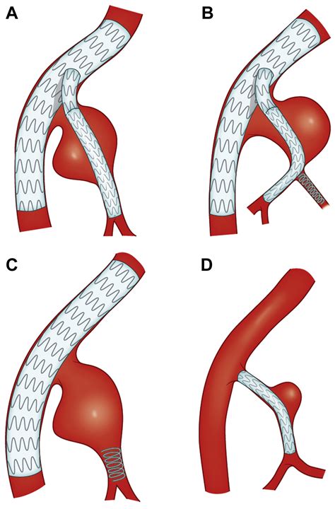 Endovascular treatment of hypogastric artery aneurysms - Journal of ...