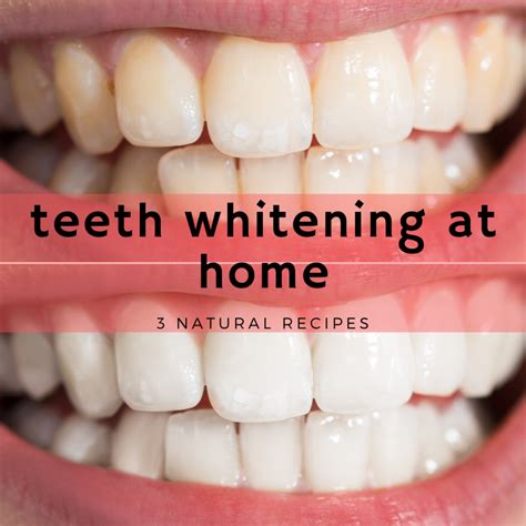 How To Whiten Teeth With Braces Diy - The whitening ingredients will only be effective on the ...