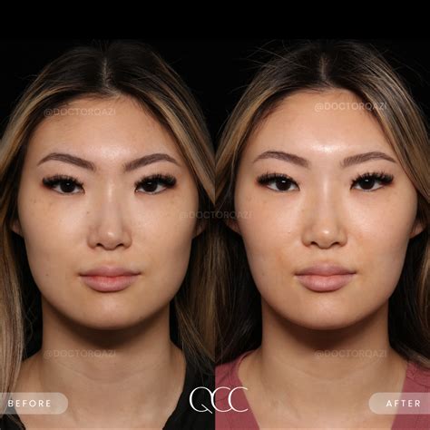 Should I Clench My Jaw After Masseter Botox at Andrew Gillan blog