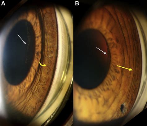 pigment dispersion: pigment dispersion syndrome causes – QAYO
