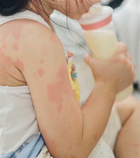 Dairy Allergy Rash In Infants at Micheal Gustin blog