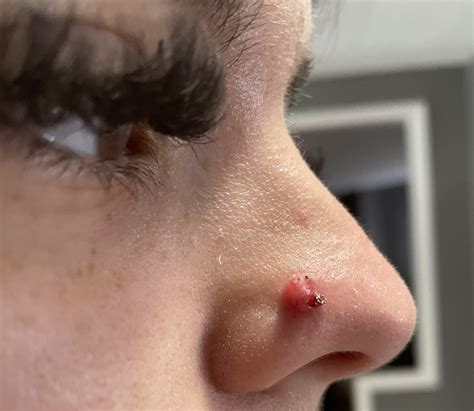 Nose Piercing Infection Bump