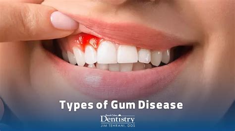 Diseased Gums What Is Periodontal (Gum) Disease