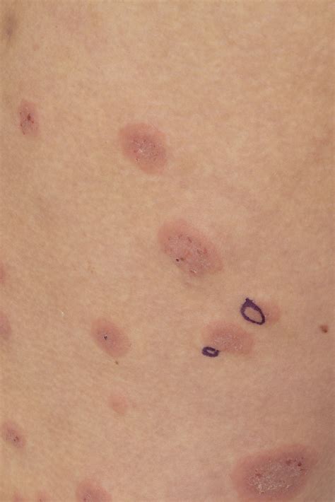Pruritic Skin Eruption in a Pregnant Woman - Mayo Clinic Proceedings