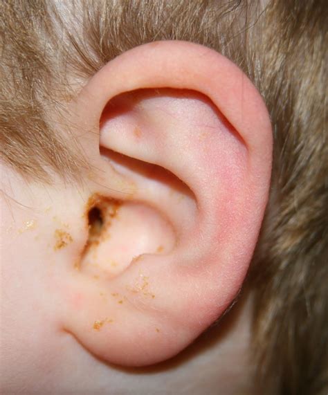 Ear Infection After Tubes Put In at Karen Ruhl blog