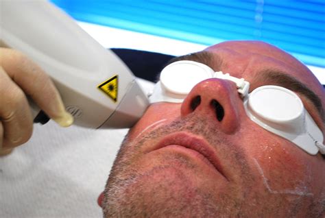 Men's Laser Hair Removal Guide // Canova Medical, Wilmslow
