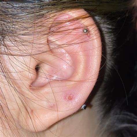 Infected Ear Piercing Hole
