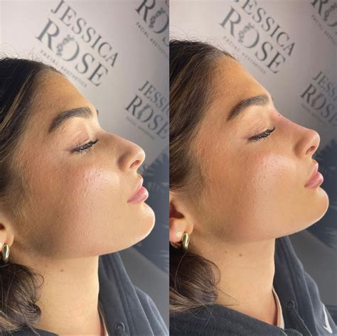 perfect nose, small nose, button nose, nose job, non surgical nose job, filler nose job, nose ...
