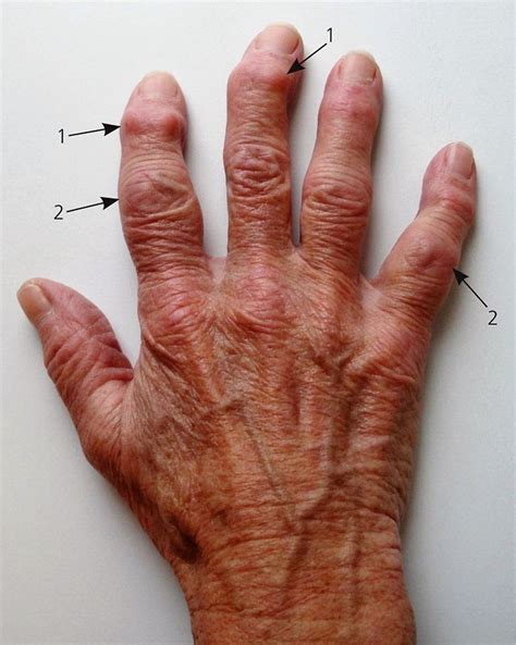 Hand Joint Osteoarthritis Treatment – QRORQ