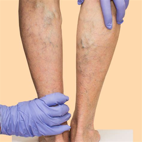 Leg Swelling Venous Insufficiency at Margaret Cass blog