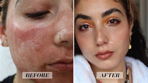 I Tried Fractional CO2 Laser Treatment, and I'm Amazed by the Results — See Photos | Allure