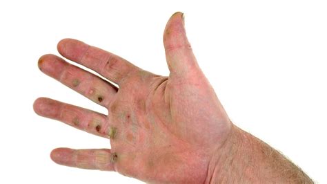 What are the Causes, Symptoms, and Treatment of Blood Blisters?