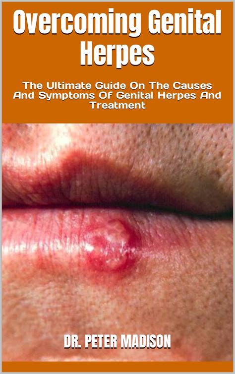 Overcoming Genital Herpes : The Ultimate Guide On The Causes And Symptoms Of Genital Herpes And ...
