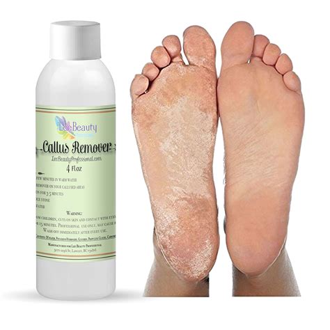 Como Se Usa Liquid Corn & Callus Remover at Vivian Donnelly blog