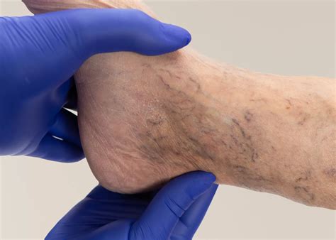 Varicose Veins Feet & Ankles | Canberra Veins | R Clinic