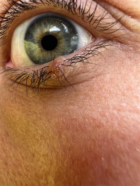 Mole Removal - Lower Eyelid : r/PlasticSurgery