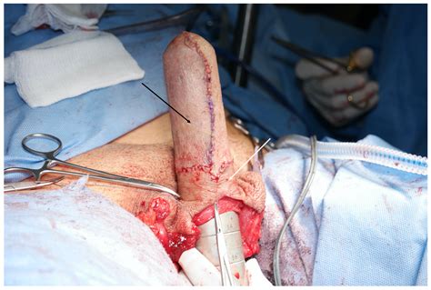 Penis Extension Surgery