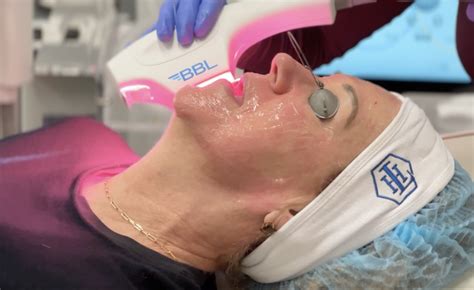 What Is BBL Laser? My Honest Review After 14 Years Of Performing This Treatment | The Skin ...