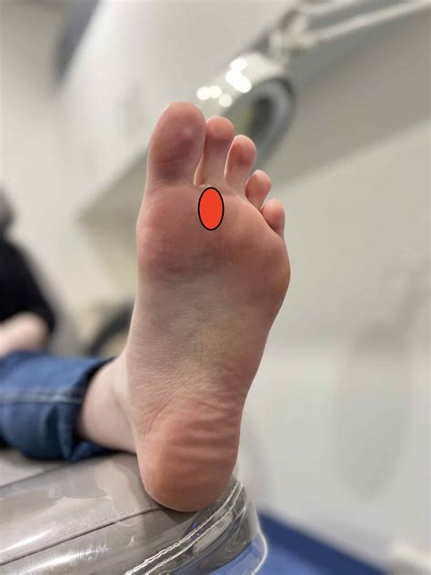 Second Toe Pain When Walking