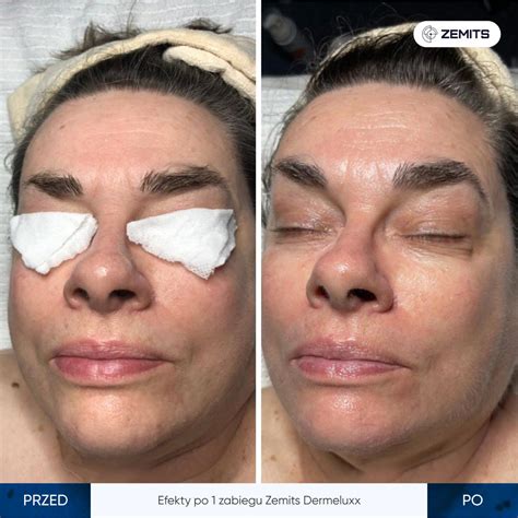 Urządzenie do dermabrazji wodnej i infuzji tlenowej Zemits Dermeluxx Pro kupić w Polsce