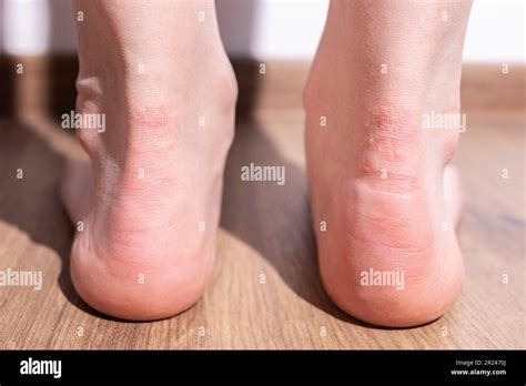 Foot Itching On Heel at Harold Herron blog