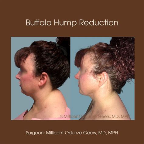 Buffalo Hump Removal