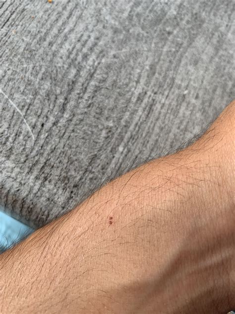 Bat Bite Mark