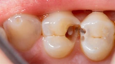 Black Lines on Teeth: Causes & Treatment Options In Bassendean
