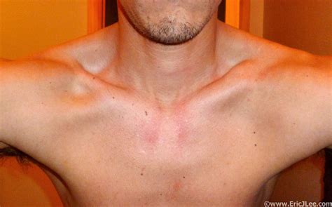 Healed Broken Clavicle