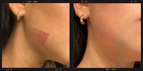 How To Cover A Burn Blister With Makeup - Mugeek Vidalondon