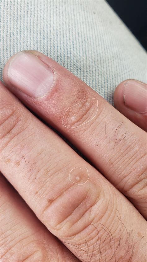 tiny white bumps on hands. warts? : r/Warts
