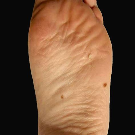 Moles on the soles of the feet and palms of the hands