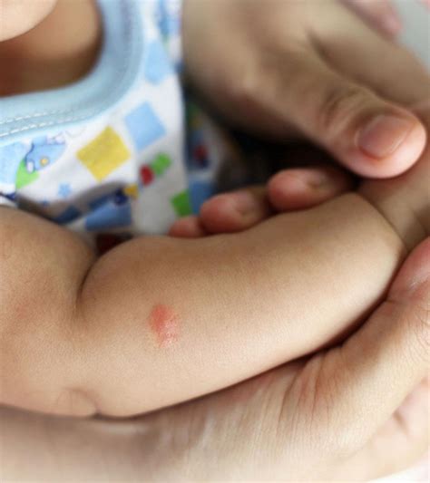 Cockroach Bite Marks On Baby