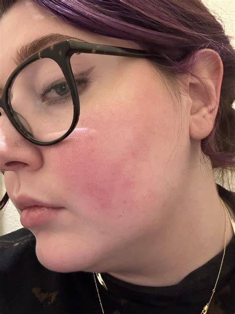 Red hot spots common with pots? : r/POTS