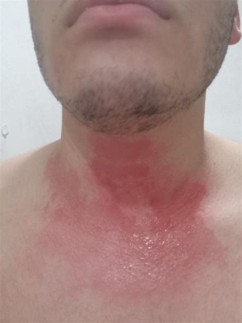 Severe itching and burning rash : r/AskDoctorSmeeee