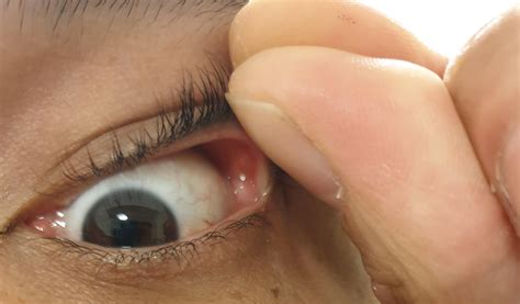 Fat Cysts Eyelids Correction Of Mild To Moderate Sunken Upper Eyelids