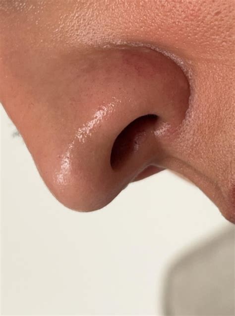 Bumps on nose : r/DermatologyQuestions