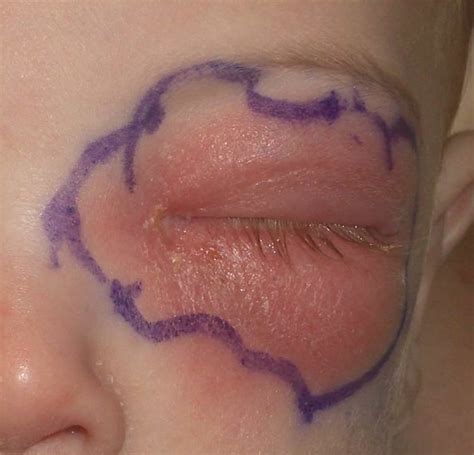 Periorbital cellulitis, Orbital cellulitis, causes, symptoms, diagnosis & treatment