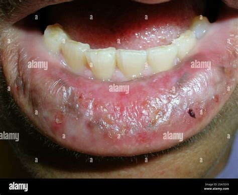 Nodular prurigo on a patient's lip. This condition is characterised by ...